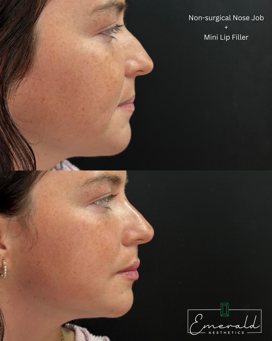 Comparison of a woman's profile before and after a non-surgical nose job, and lip filler.