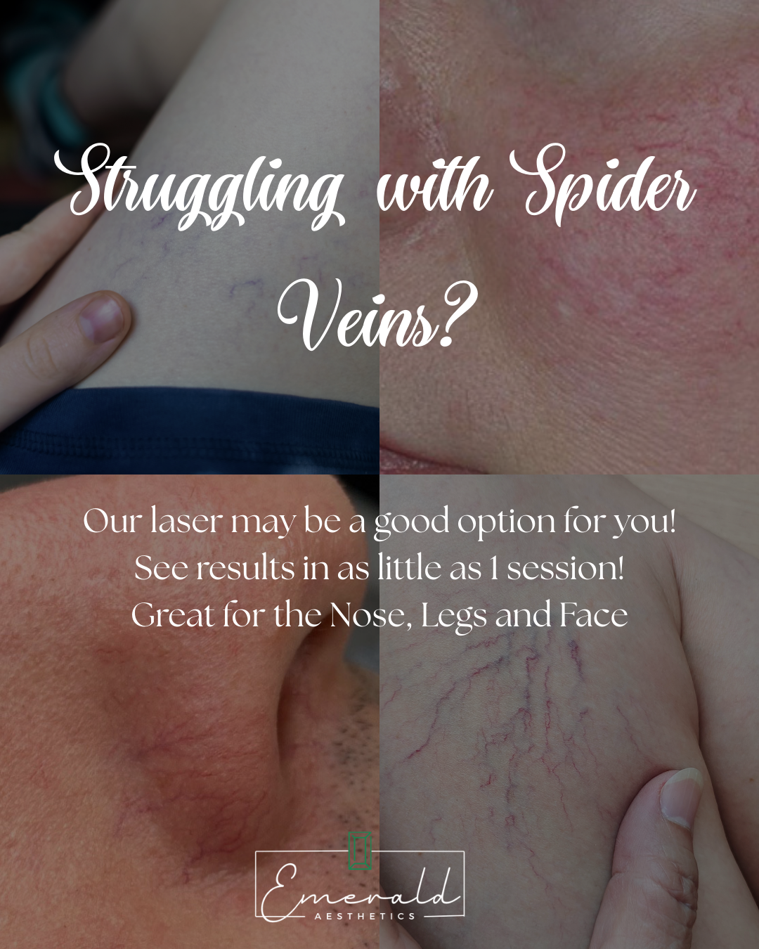 Advertisement for spider vein laser treatment: close-up of skin with spider veins, text promoting laser treatment and mentioning results.