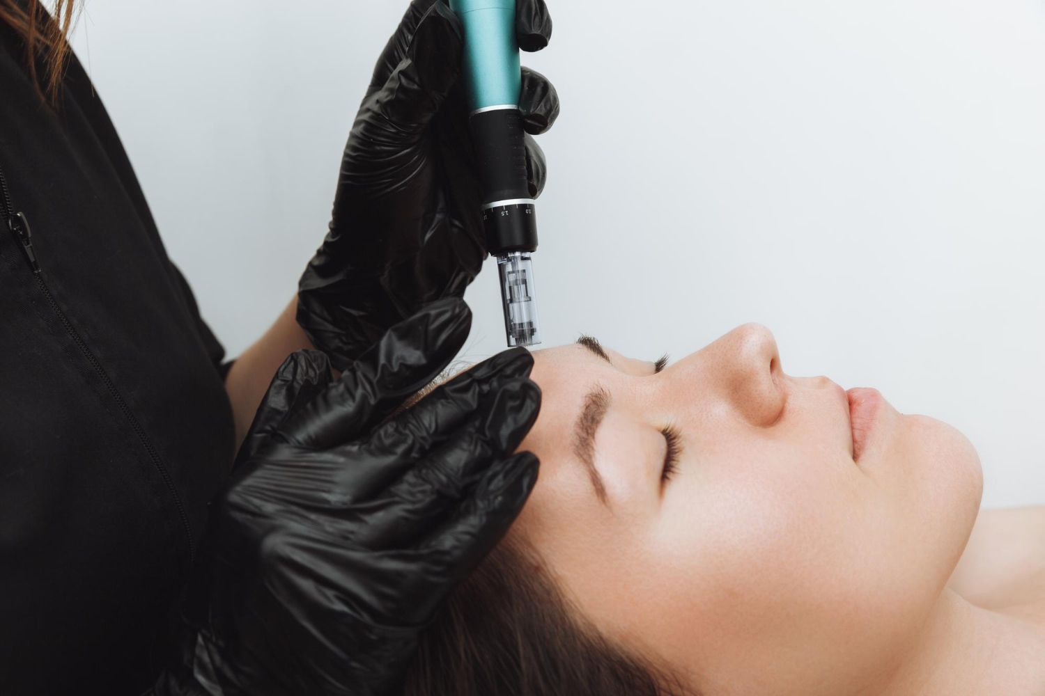 Person receiving microneedling treatment on the forehead, with black-gloved hands holding the device. White background.