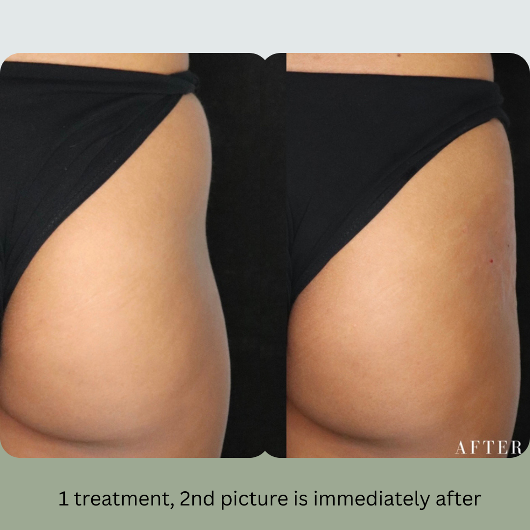 Comparison of a buttock before (left) and immediately after (right) a single treatment, showing reduced cellulite appearance.