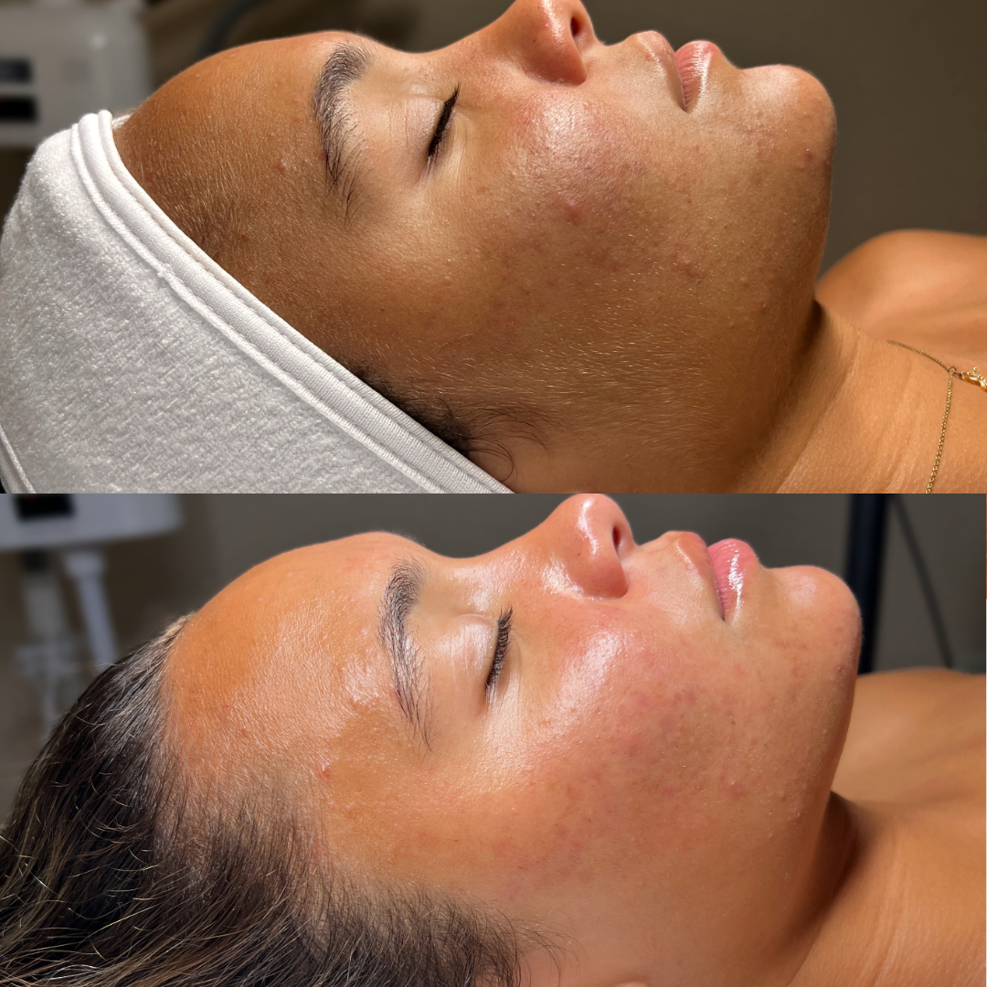 A before and after photo of a woman getting a facial treatment.