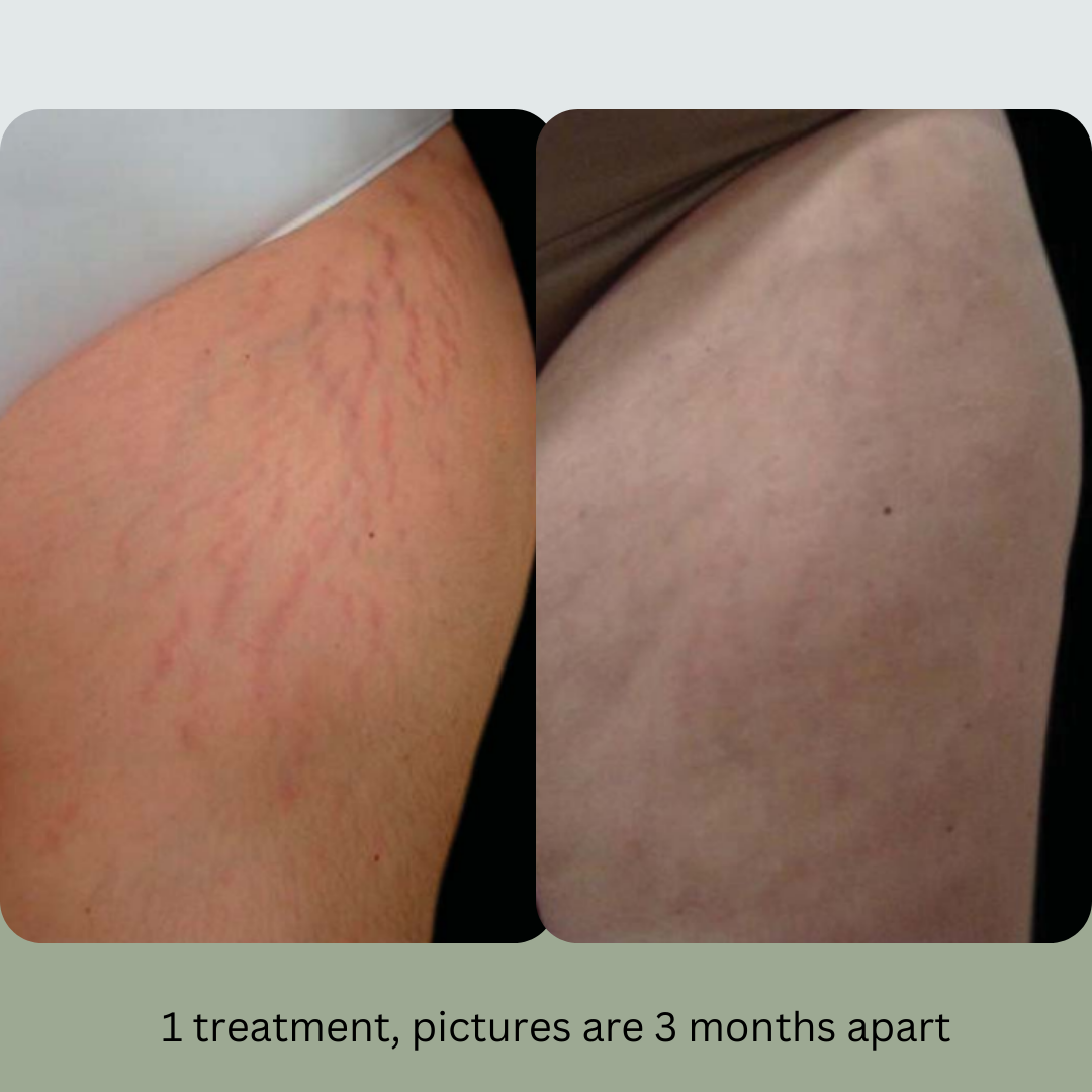 A before and after picture of a person 's leg with the caption 