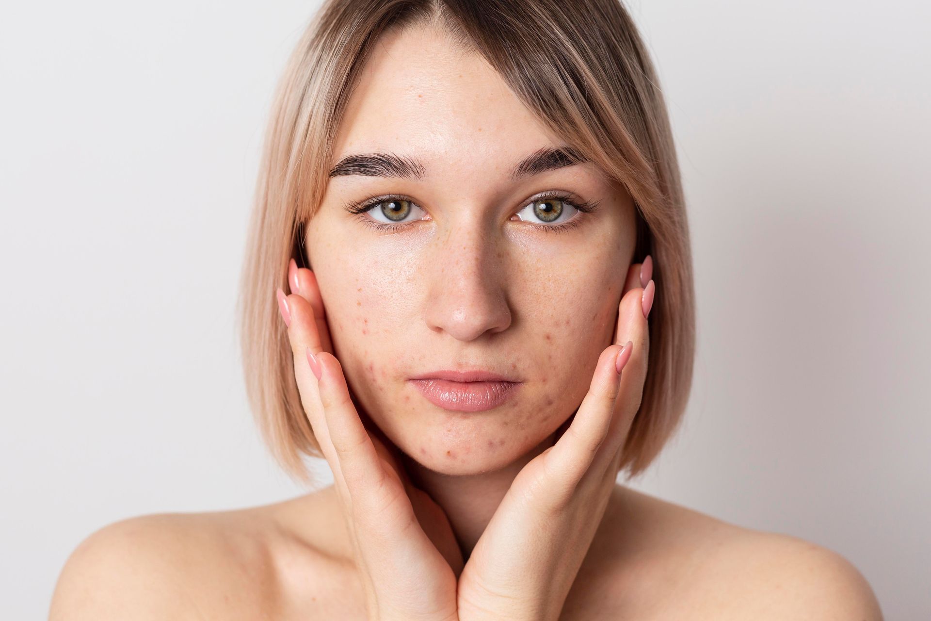 A woman with acne on her face is touching her face with her hands.