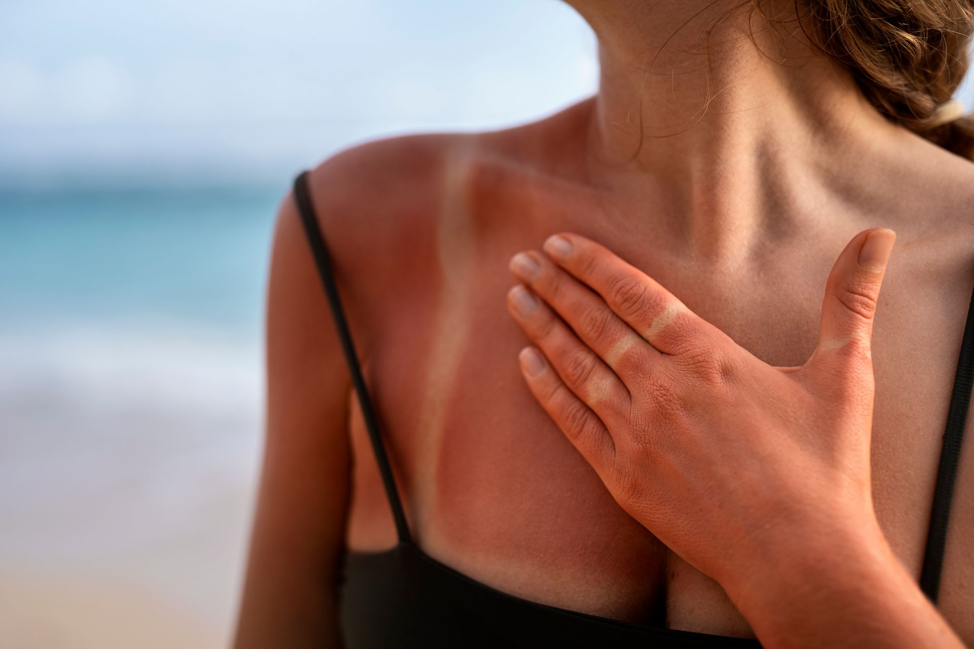 Woman with sunburn on chest and shoulder, hand touching affected area, beach in background.