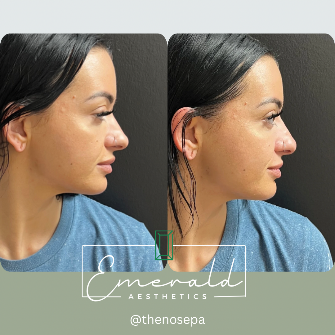 A before and after photo of a woman 's nose