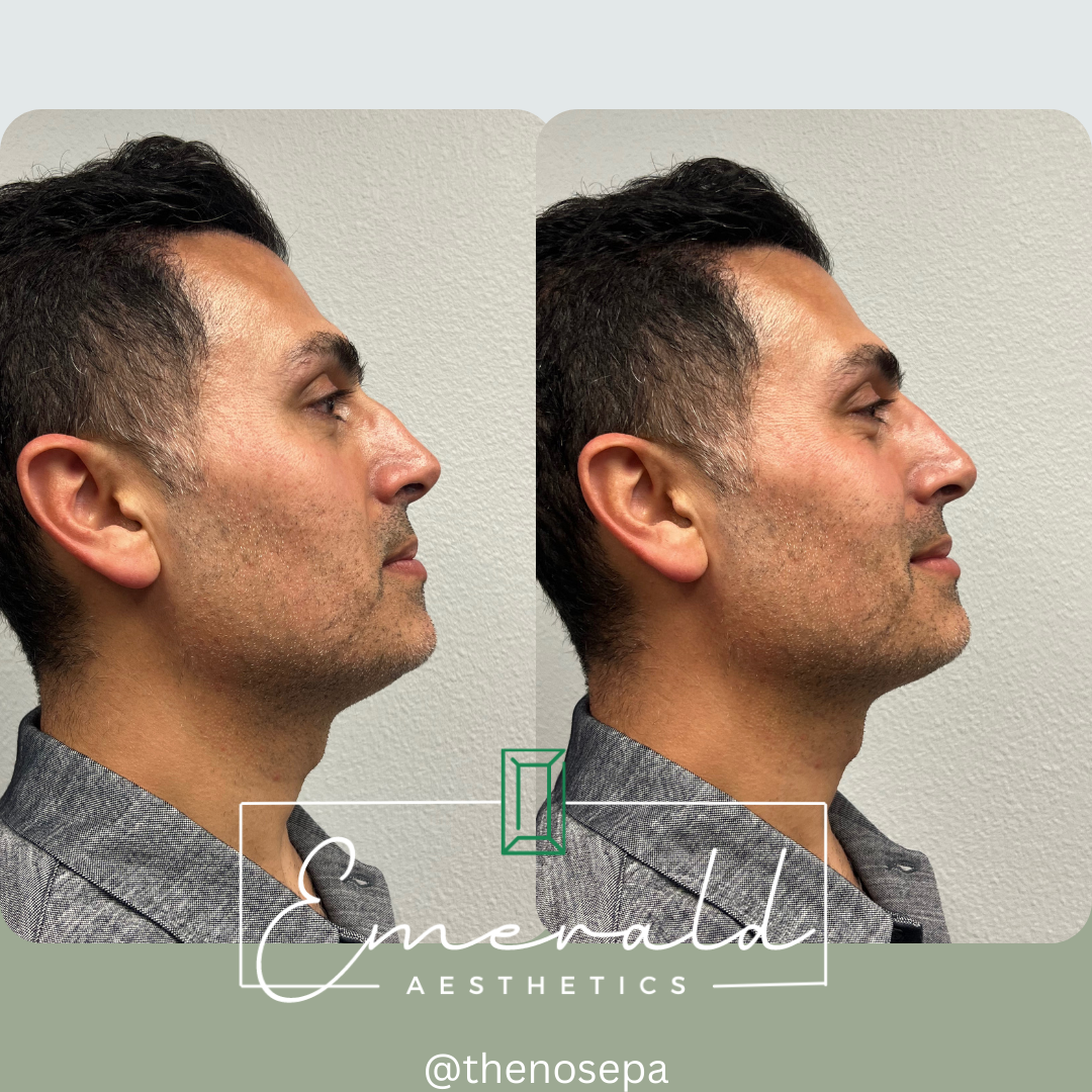 A before and after photo of a man 's face.