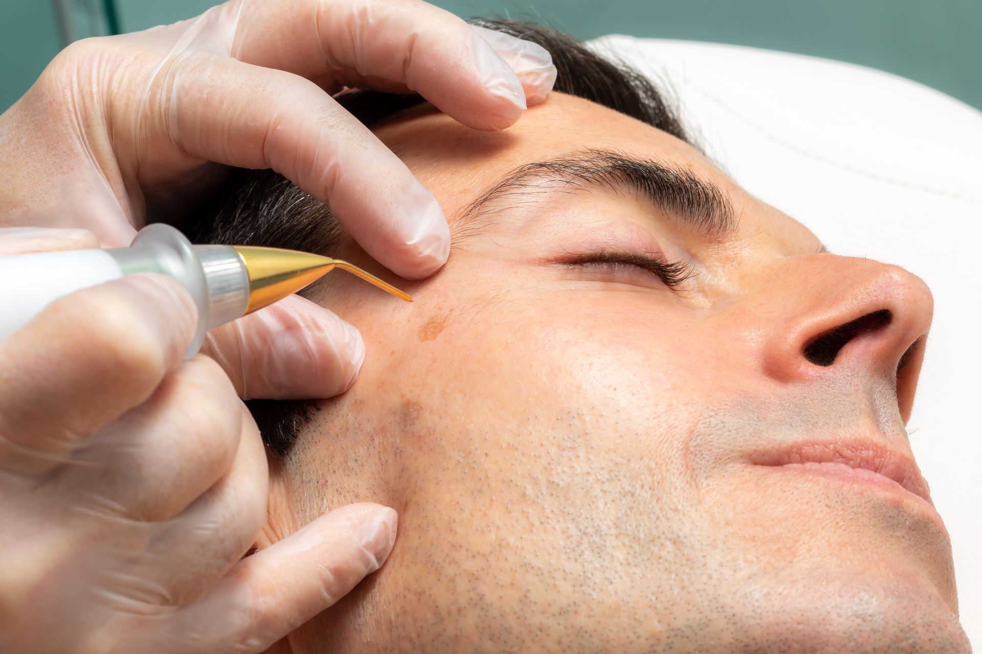 A man is getting a laser treatment on his face.