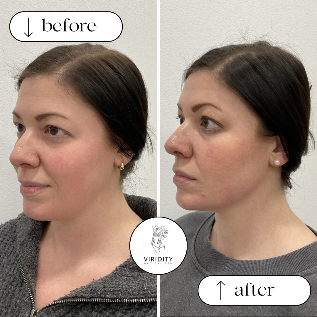 Side-by-side before/after comparison of a woman's face; the "after" view shows a more defined jawline.