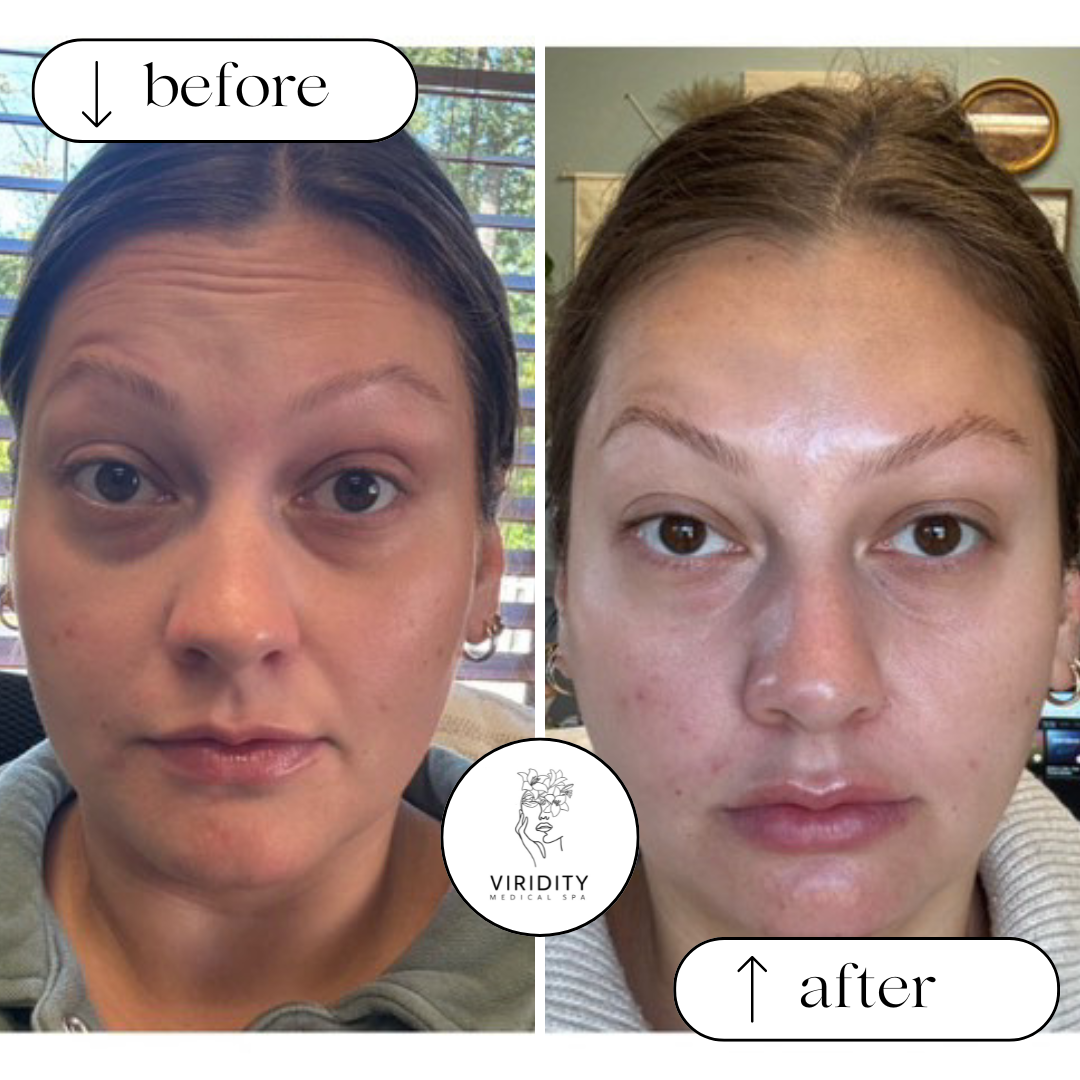 Side-by-side facial comparison: before (left), and after (right) cosmetic procedure. Reduced forehead wrinkles, smoother skin.