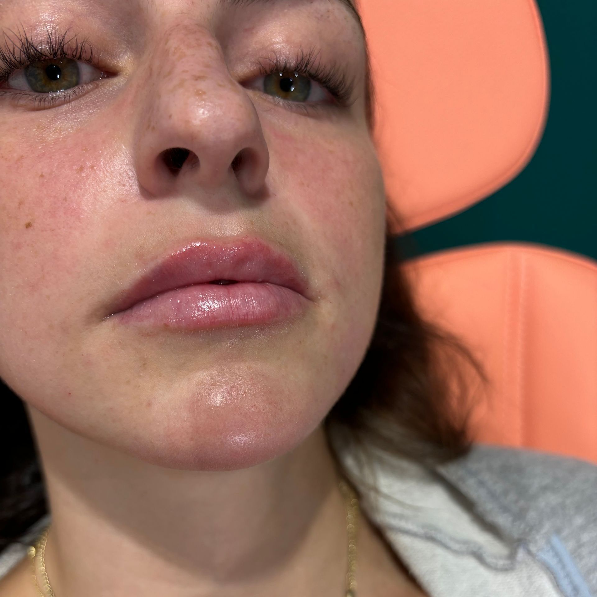 Woman with full, shiny lips and slight redness, wearing a gray top, seated.