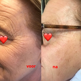 Een voor en na foto onmiddellijk na de behandeling