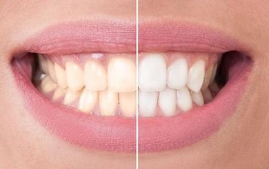 trattamenti di cosmetica dentale