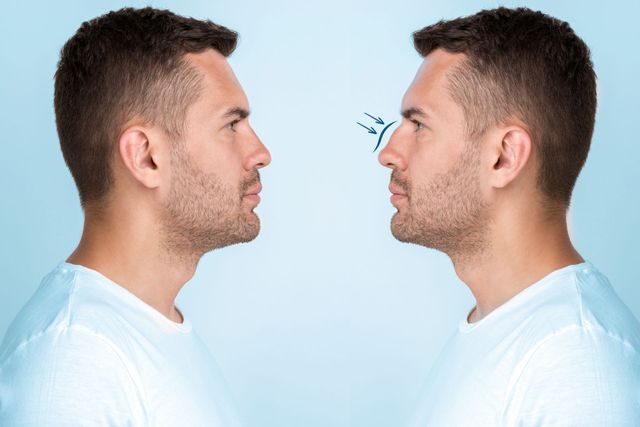 Rinoplastia Masculina: como funciona a cirurgia de nariz para os