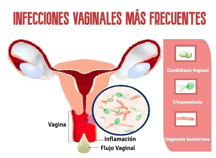 ¿Qué son las infecciones vaginales?