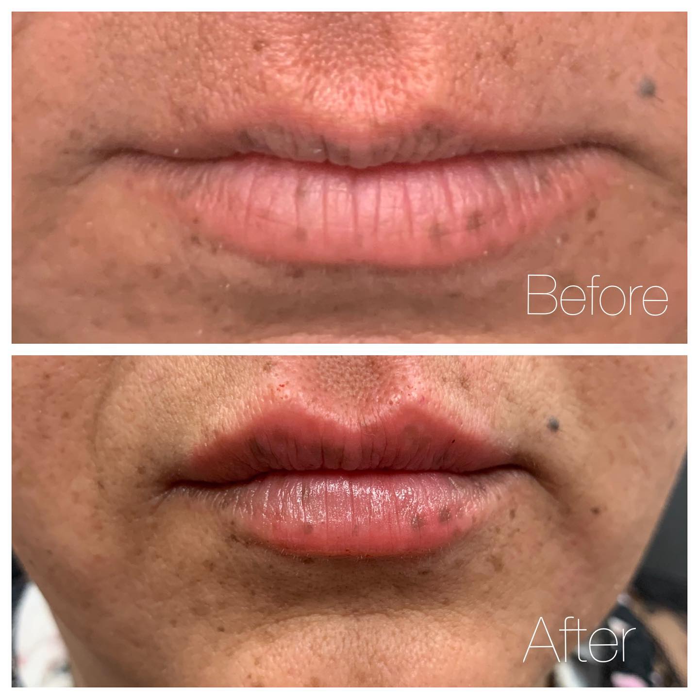 Before and After Lip Filler — Casper, WY — Pretty Please Aesthetics