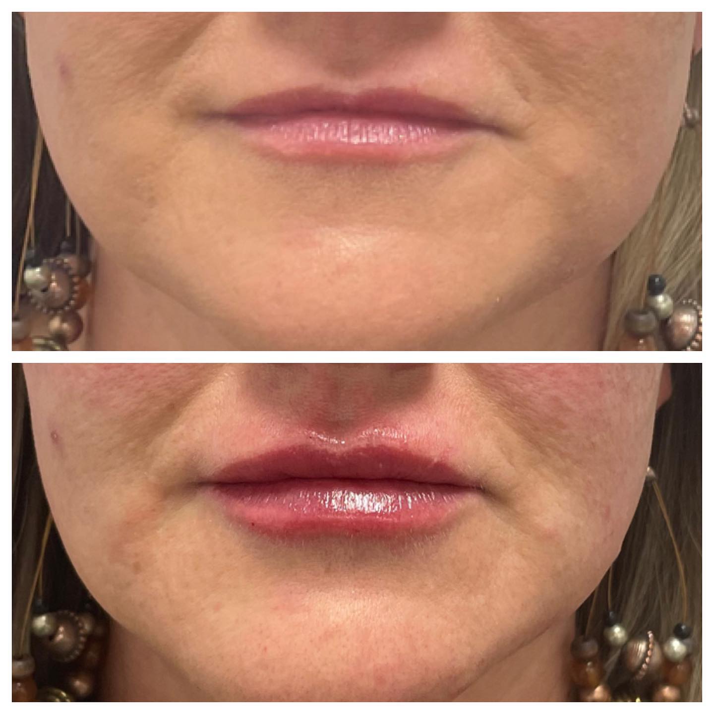 Before and After Chemical Peels — Casper, WY — Pretty Please Aesthetics