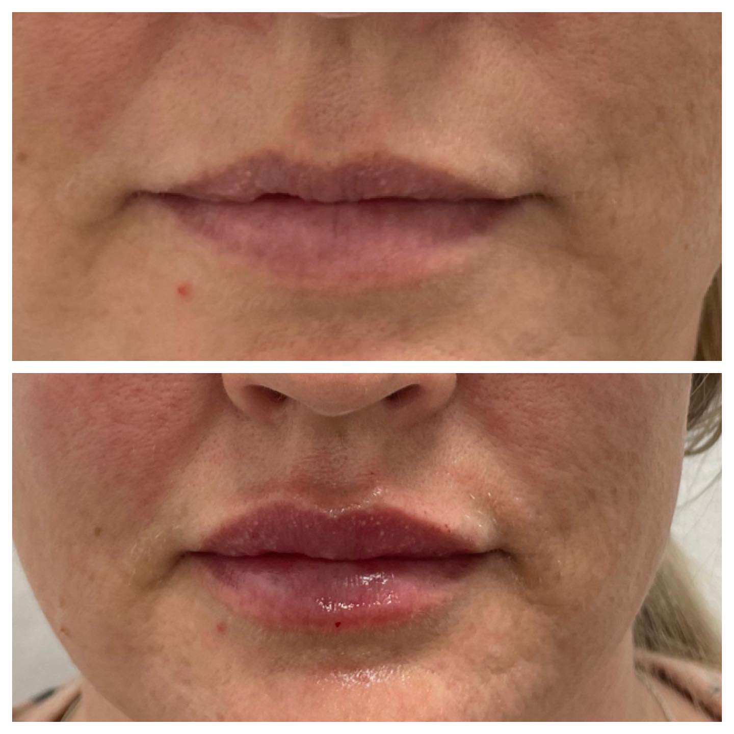 Before and After Lip Enhancement — Casper, WY — Pretty Please Aesthetics