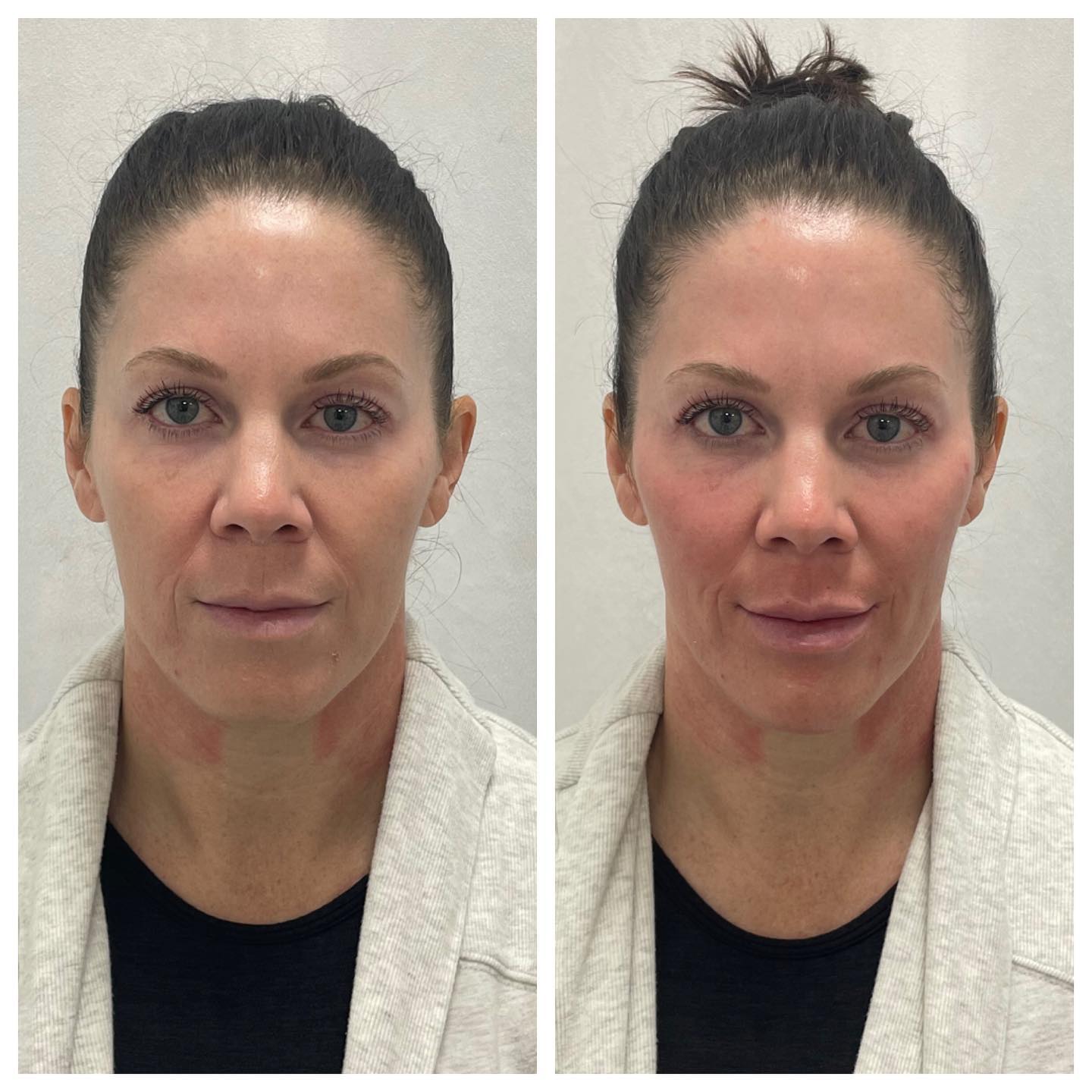 Before and After Treated Cheeks — Casper, WY — Pretty Please Aesthetics