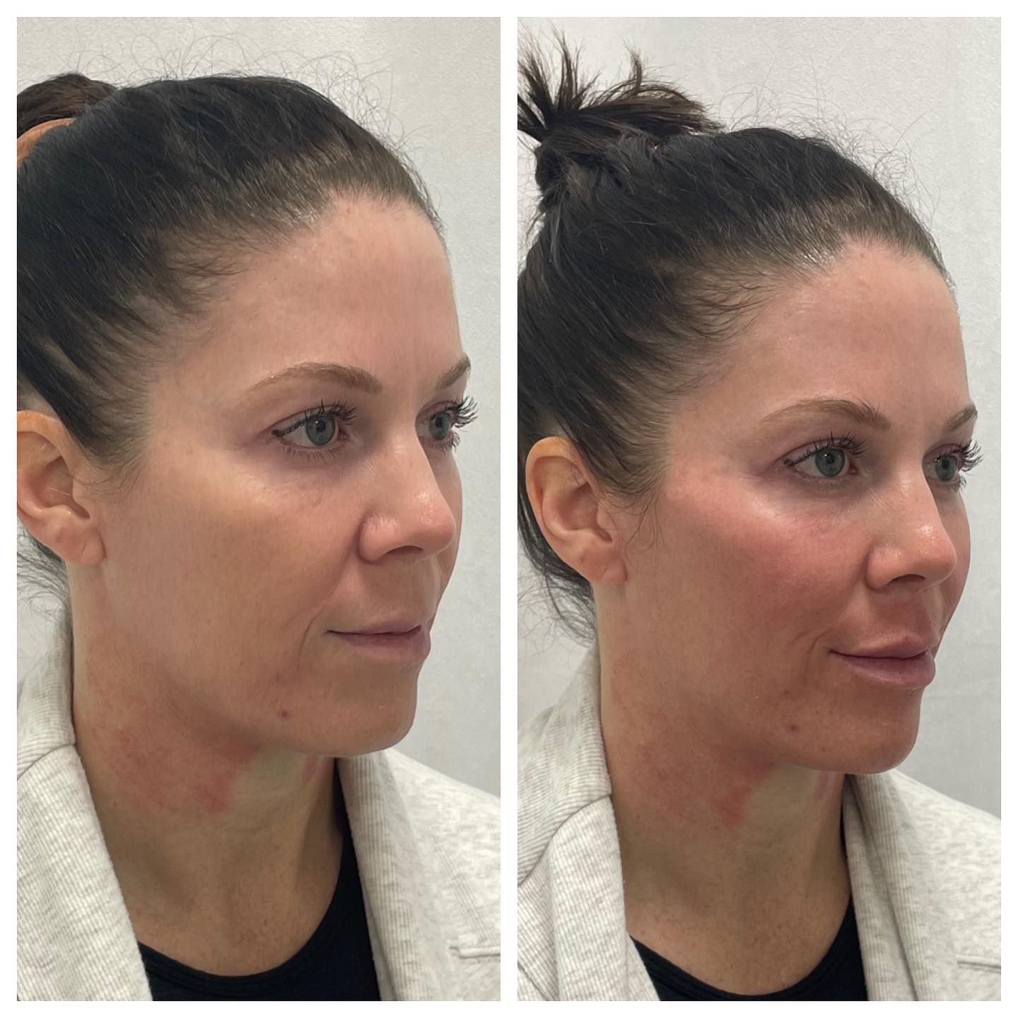 Before and After Smoother Skin — Casper, WY — Pretty Please Aesthetics