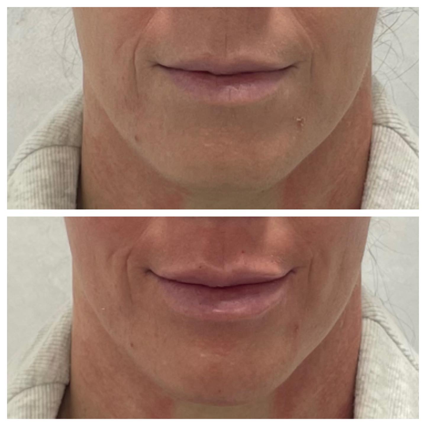 Before and After Lips Treatment — Casper, WY — Pretty Please Aesthetics