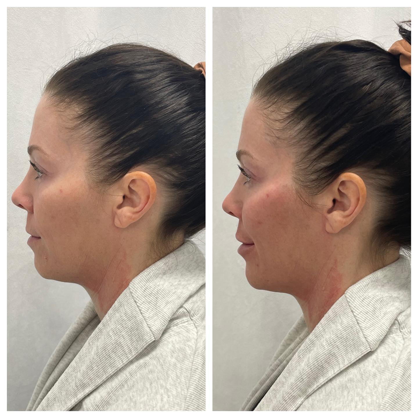 Before and After Left Cheeks — Casper, WY — Pretty Please Aesthetics