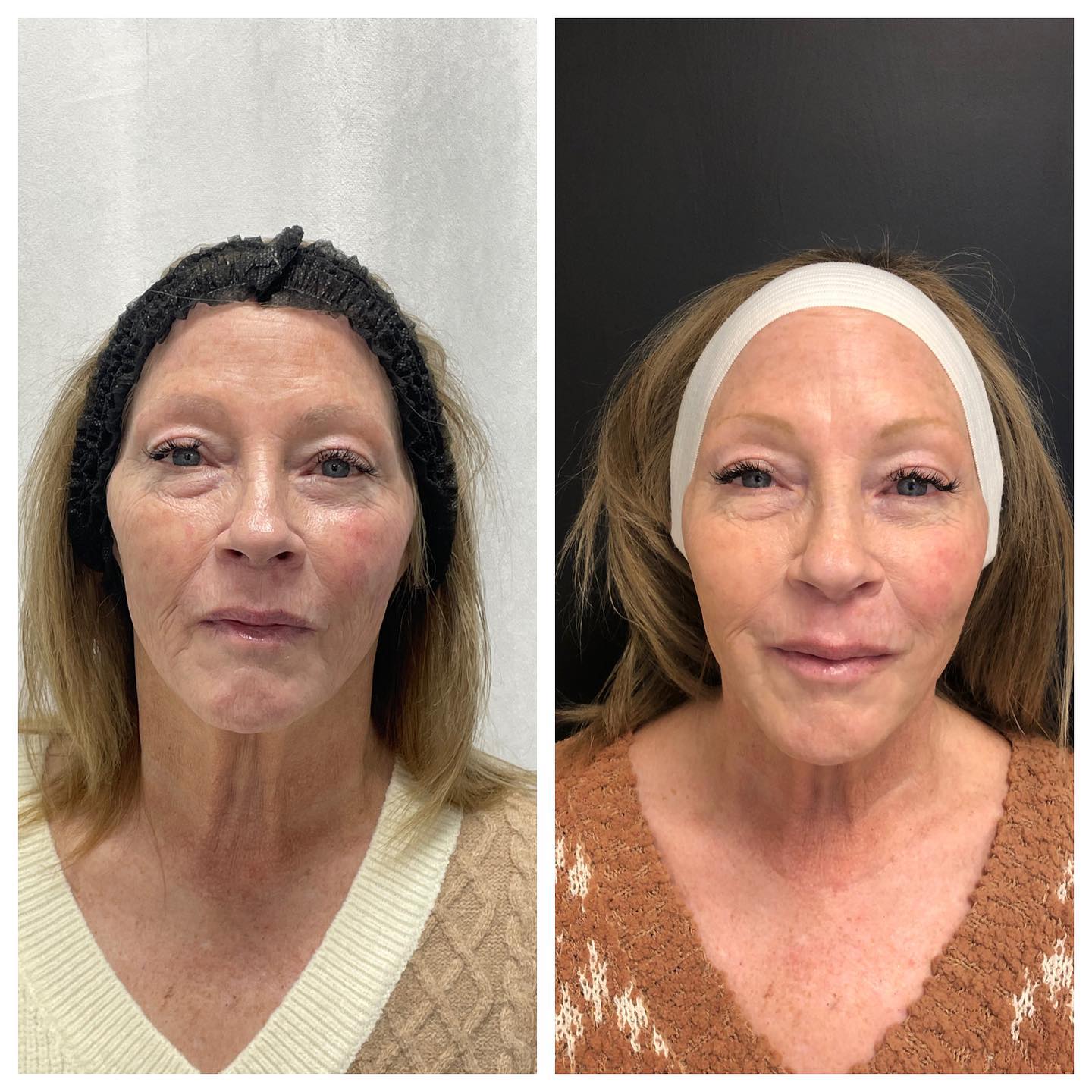 Before and After Facial Treatment — Casper, WY — Pretty Please Aesthetics