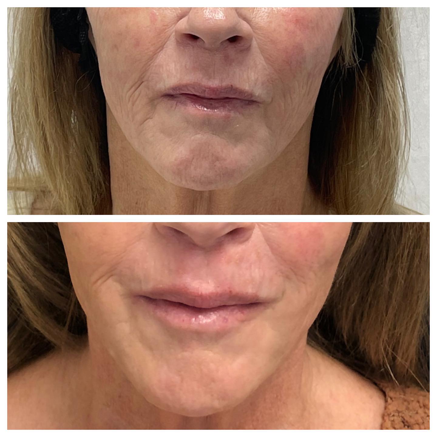 Before and After Dark Patches and Freckles — Casper, WY — Pretty Please Aesthetics