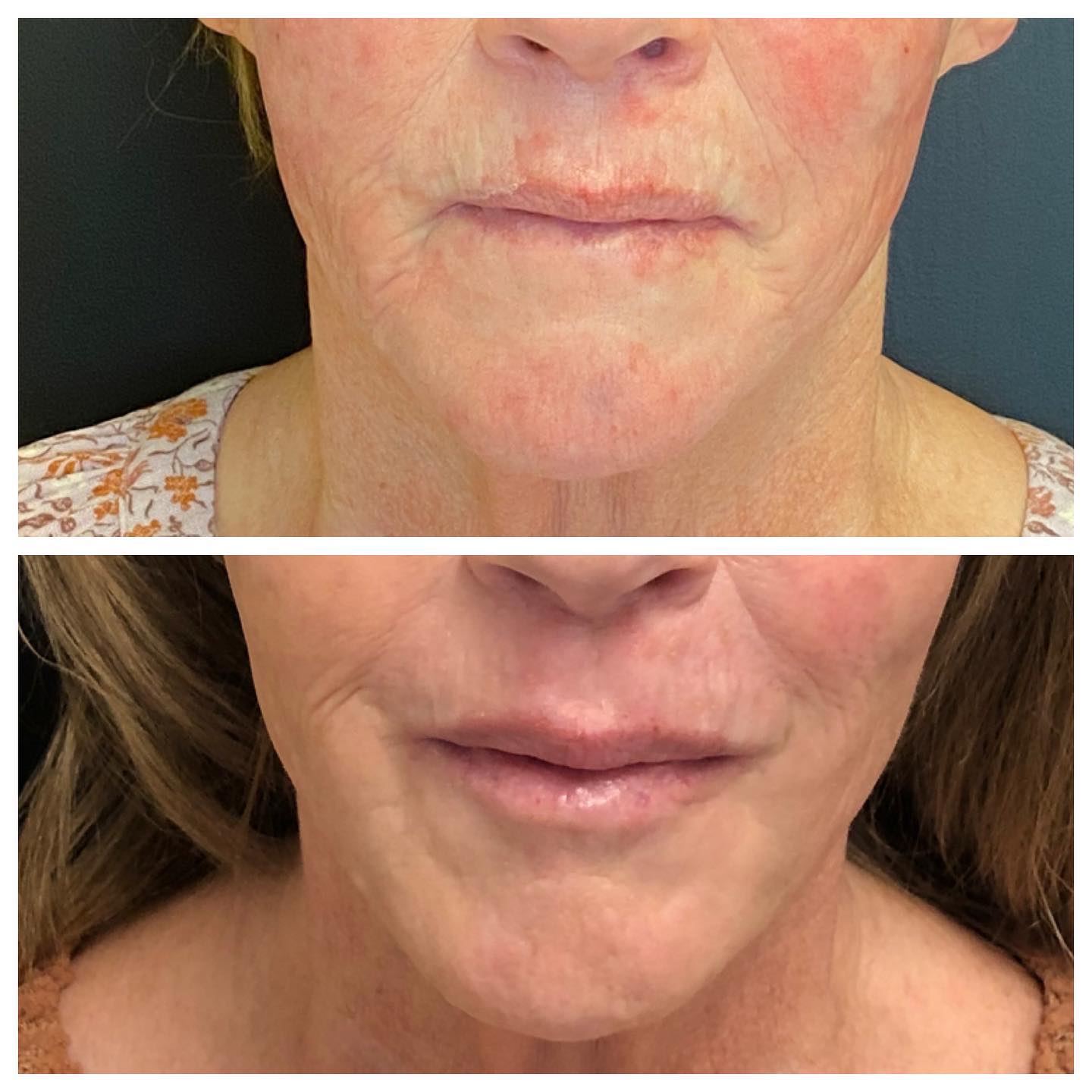 Before and After Juvederm Treatment — Casper, WY — Pretty Please Aesthetics