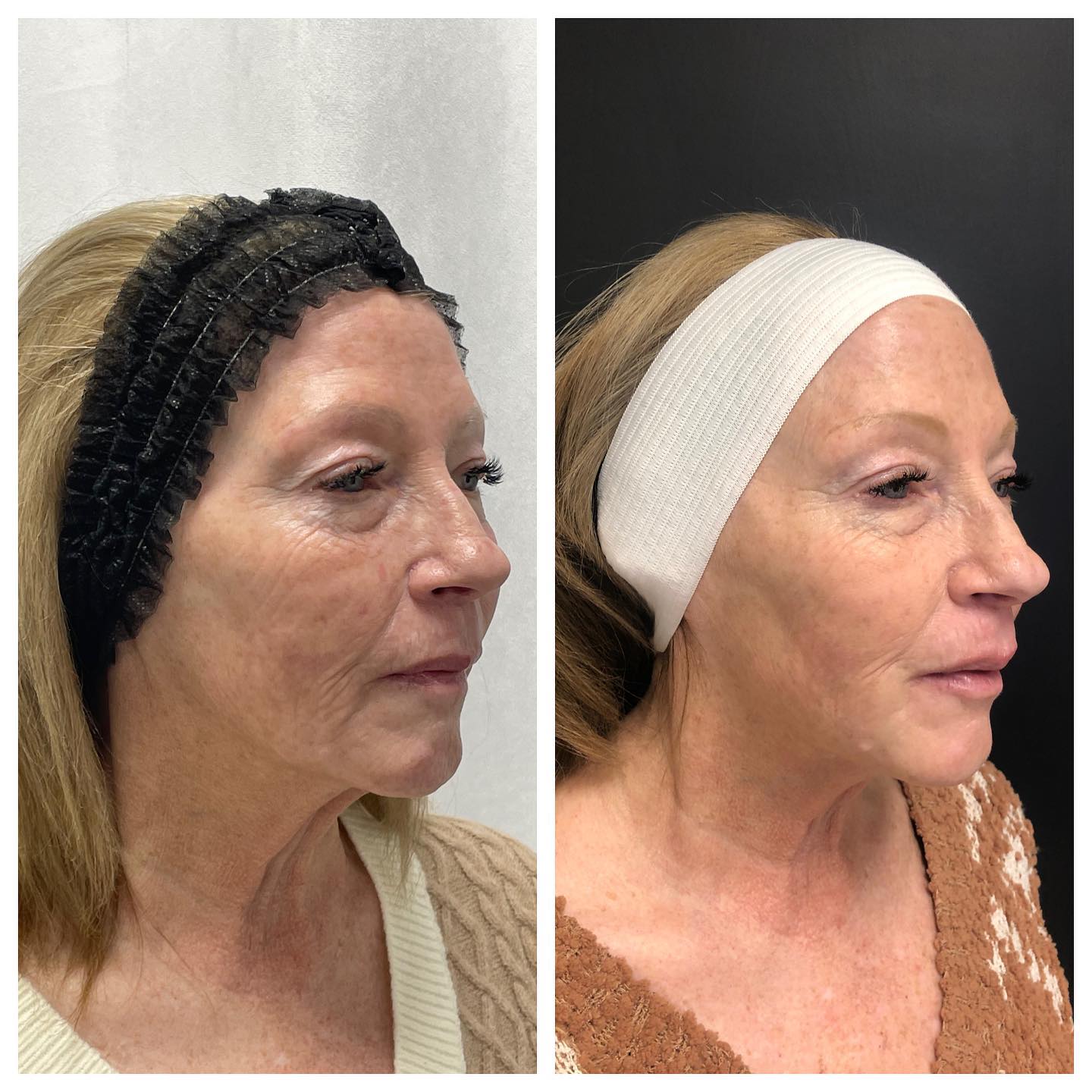 Before and After Laser Treatment — Casper, WY — Pretty Please Aesthetics