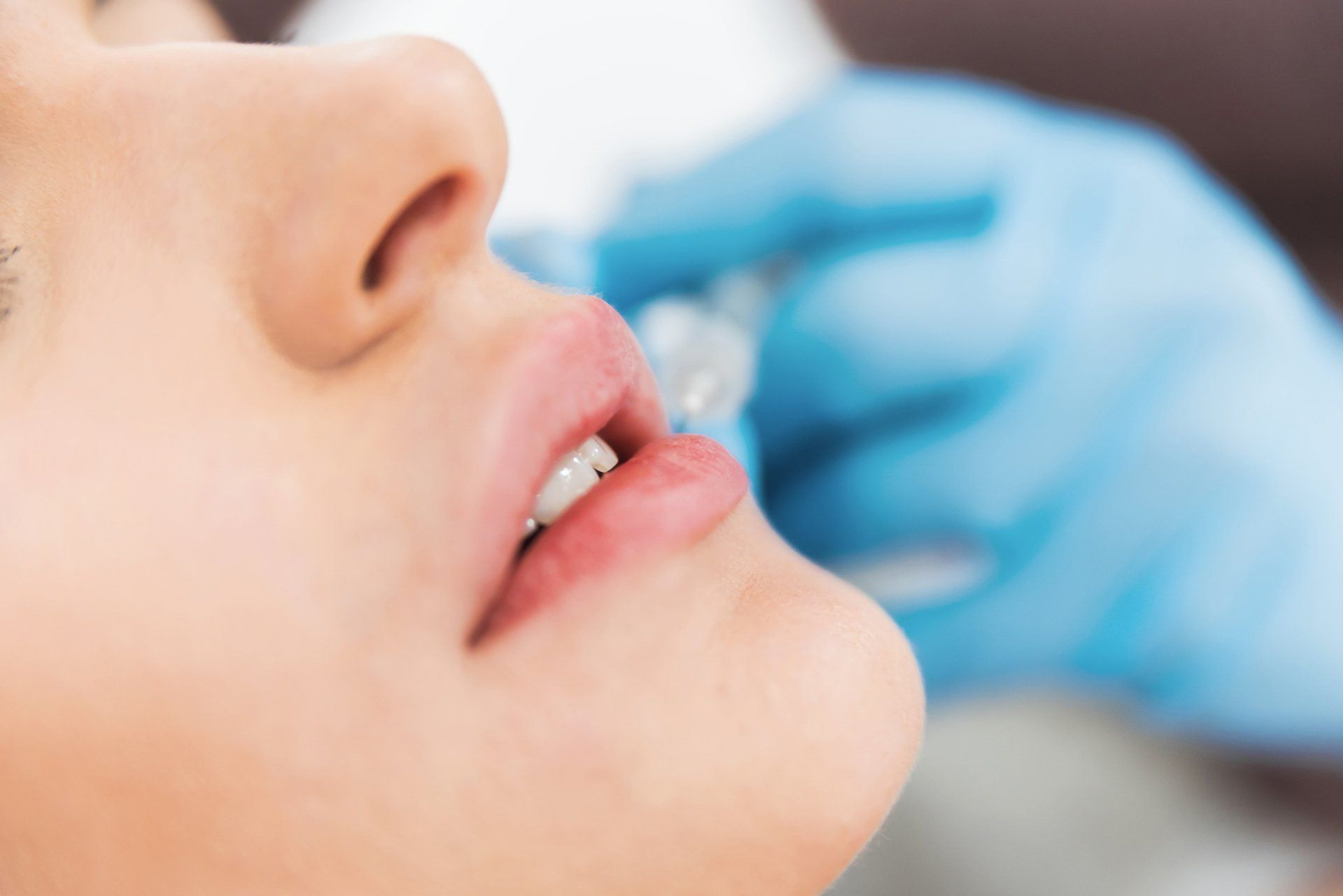 Lip Hyaluron Filler — Casper, WY — Pretty Please Aesthetics