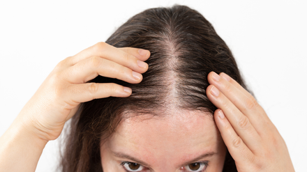Woman parting hair, showing thinning hair on the scalp; hands frame the head.