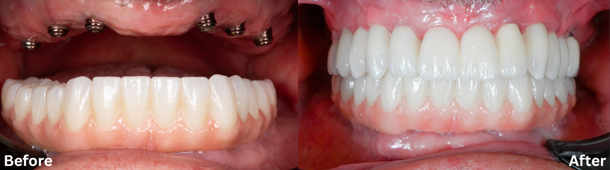 Comparison of dental implants before and after; showing gaps replaced with teeth.