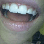 Photo of Teeth Before Receiving Composite Filling