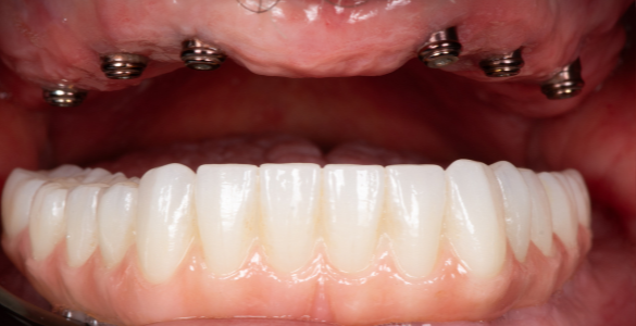 Comparison of dental implants before and after; showing gaps replaced with teeth.