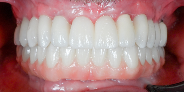 Comparison of dental implants before and after; showing gaps replaced with teeth.