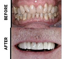 StarBrite Dental Patient Before and After Photos - GP