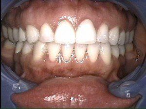 Teeth With Dental Veneers