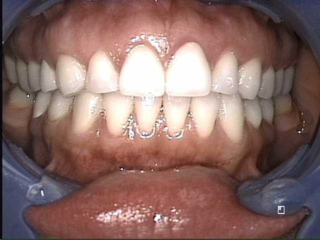 Image of Heidi's Teeth After Dental Veneers