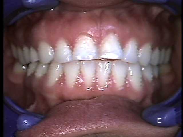 Image of Heidi's Teeth Before Dental Veneers
