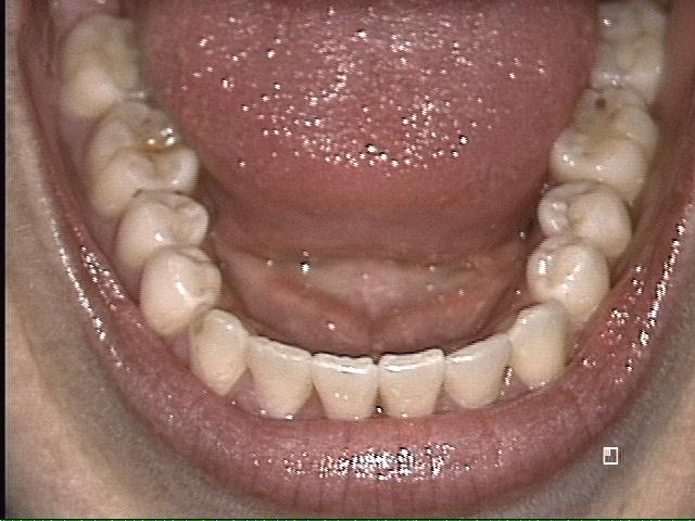 Kathryn Lower Arch After Invisalign