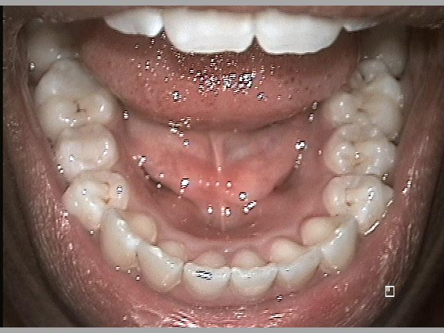 Lower Arch After Invisalign
