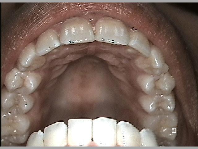 Upper Arch of Teeth After Invisalign