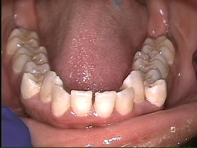 Lower Arch of Teeth Before Invisalign