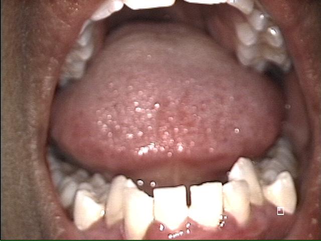 Lower Arch Before Invisalign