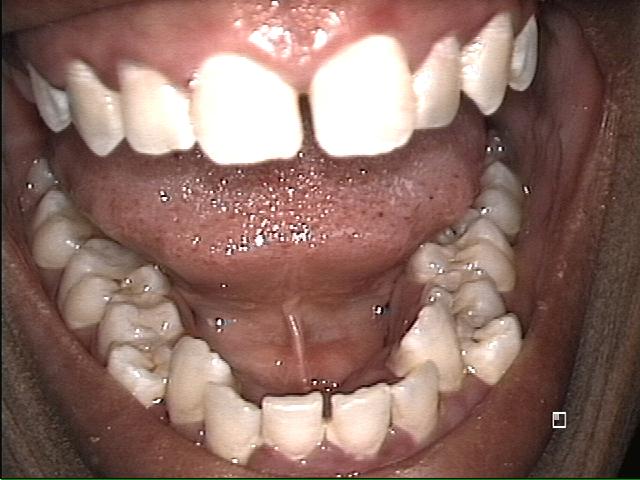 Top and Bottom Teeth Before Invisalign