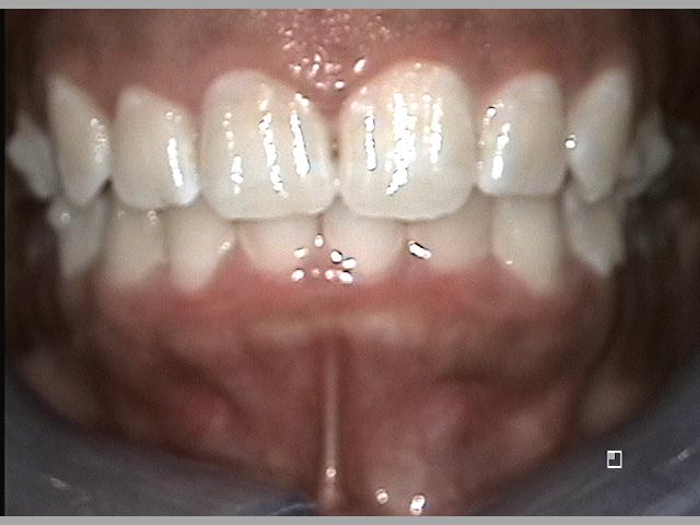 Front Teeth After Invisalign