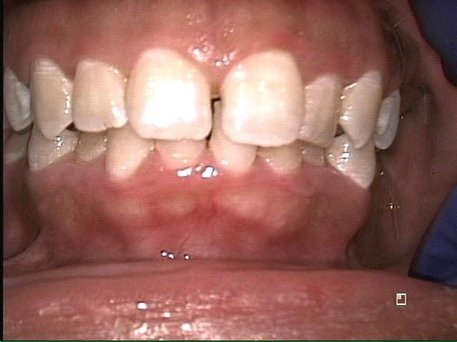 Front Teeth Before Invisalign