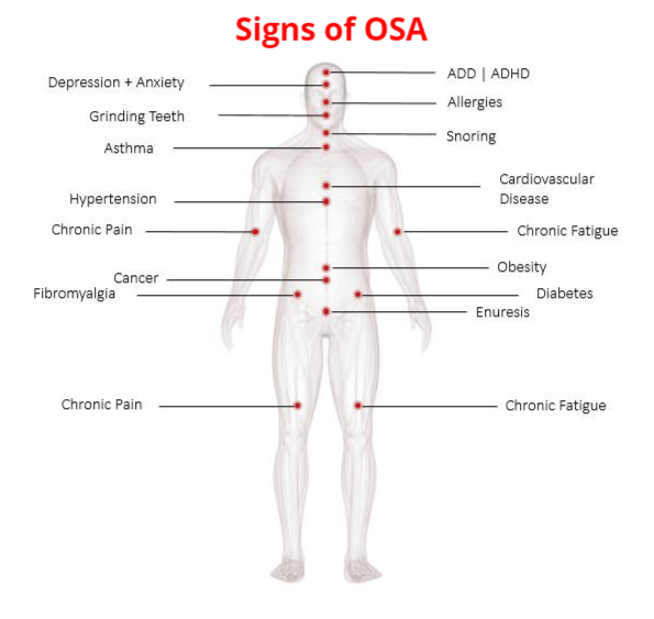 image displaying human health signs of OSA obstructive sleep apnea