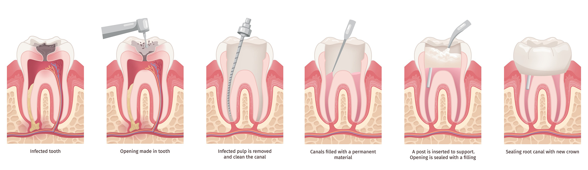Diagram of a root canal procedure, showing the different stages of cleaning and filling the tooth.