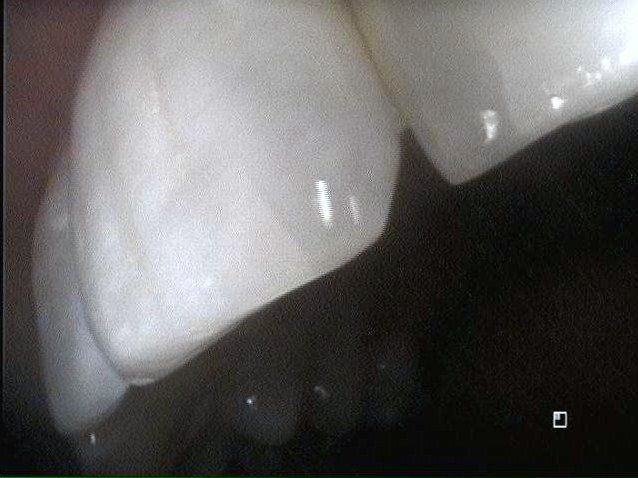 Image of Shawn's Tooth After Composite Bonding